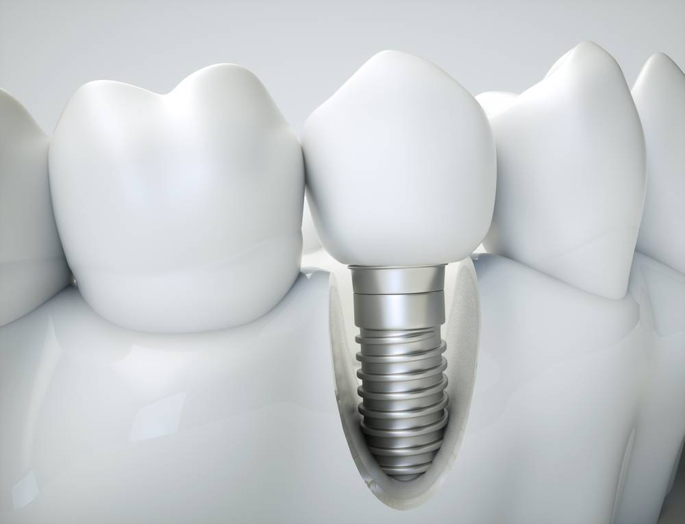 Schéma d’un implant dentaire surmonté d’une couronne entre deux dents